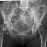 Hip Fracture Injuries May Increase Death Risk