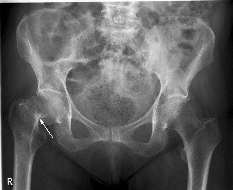 hip-fracture - Mark Risi