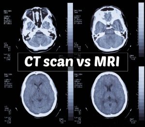 CT Scan vs MRI and Personal Injury